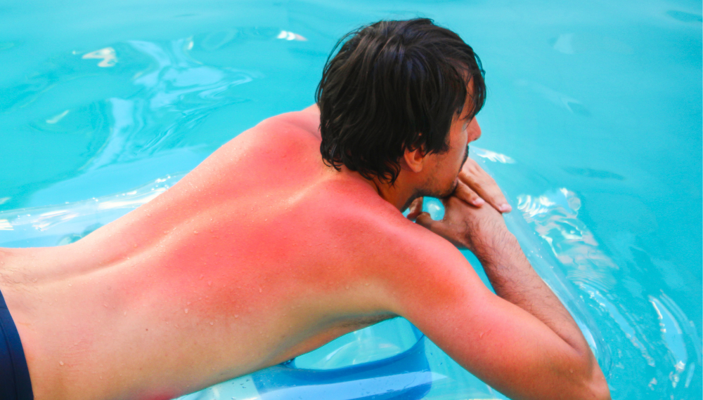 Qué hacer ante una quemadura solar: primeros auxilios y consejos para una actuación segura